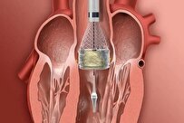 Iranian Specialists Perform Transcatheter Aortic Valve Replacement (TAVR) Successfully