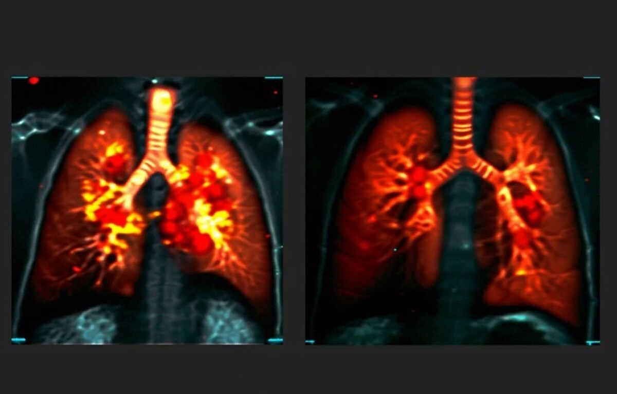 ابداع اسکن جدیدی که روند درمان بیماری‌های ریوی را متحول می‌کند