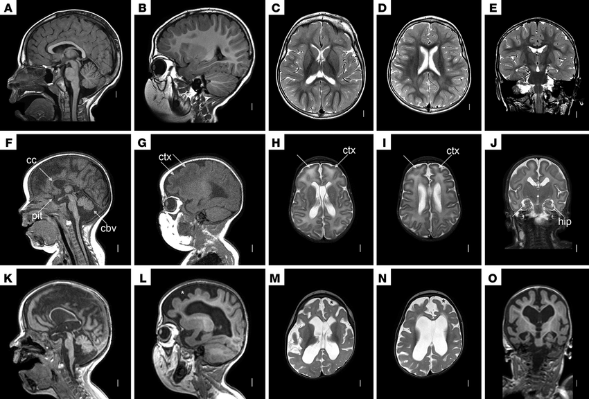 MRI-scan-images-of-patient-NM720-Brain-MRI-in-a-normal-3-year-old-child-A-E-and-in.png