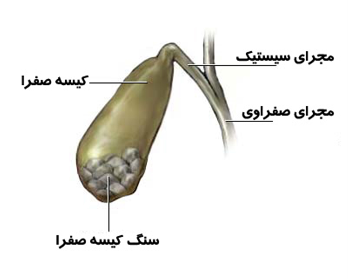 سنگ صفرا