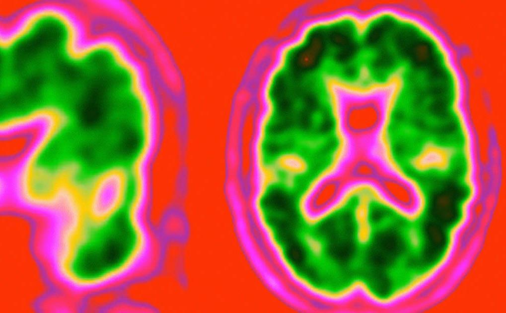 alzheimers-blood-test-20-years-early-1200x630.jpg