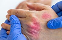 علماء يابانيون يطورون نموذج ذكاء اصطناعي لتشخيص الإكزيما