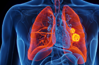 اختراق علمي جديد: علاج فعّال لسرطان الرئة عبر جسيمات نانوية