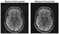 mit-researchers-combine-deep-learning-physics-to-fix-motion-corrupted-mri-scans