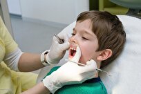 Iran-Made Dental Nanocomposite Prevents Tooth Decay