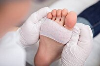 iran-made-egf-drug-treats-diabetic-foot-ulcers-burns