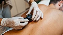 New Zealand's Most Serious Skin Cancer Deaths Drop by One Third