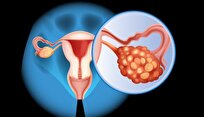 Researchers Identify New Therapeutic Target for Ovarian Cancer