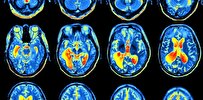 Iranian Researchers Conduct Research on Reduction in Neurological Deficits by miRNA-149-5p During Stroke