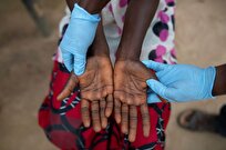 UN Sounds Alarm over Surge in Mpox Cases in Africa