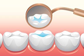 Iranian Firm Produces High-Quality Nano-Based Discs for Dental Laboratories