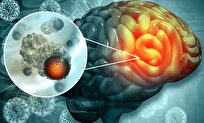 Brain Tumor Diagnosis with Iran-Made Natural Biomarkers