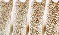 Iranian Scientists Produce Nano-Based Calcium Tablets to Prevent Osteoporosis