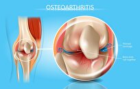 Safer Knee Osteoarthritis Treatment Provides Relief without Surgery