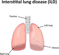 Iranian Firm Produces Special Drug for Patients with Pulmonary Fibrosis