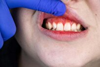 Natural Plant Compound Shows Promise for Treating Gum Disease