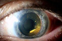 Solar-Powered Eye Implant Restores Reading Vision