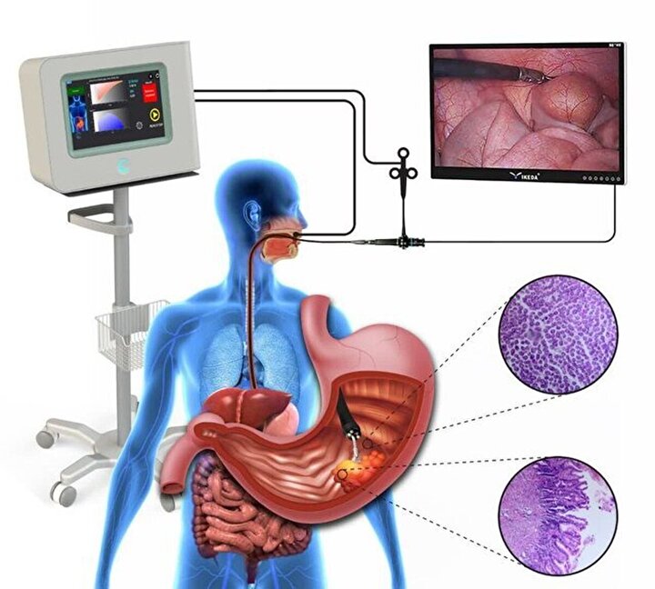 Iran-Made Device diagnoses Upper Gastrointestinal Cancers Accurately