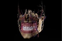 Iranian Surgeons Conduct Operation on Patient's Skull with Home-Made Absorbable Implant