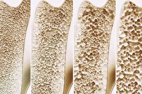 Newly Found Bone Switch That Could Stop Osteoporosis