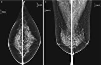 Iranian Experts Design Smart Mammography Interpretation System