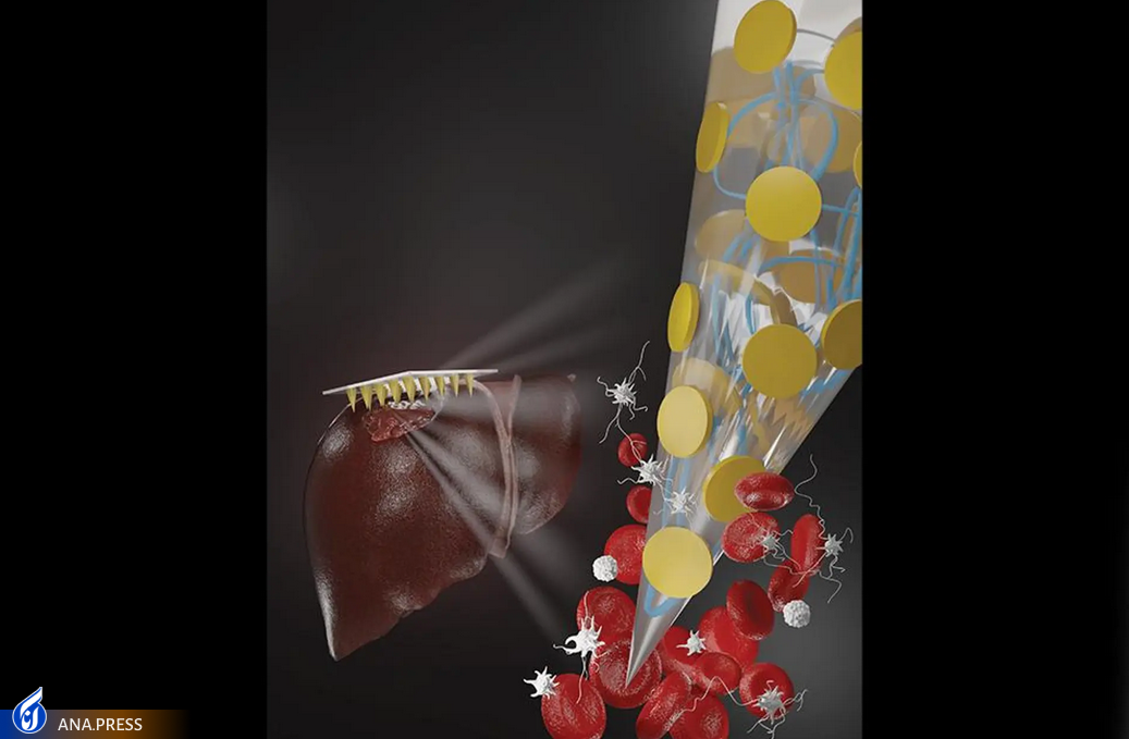 توقف سریع خونریزی با یک چسب میکروسوزنی جدید توقف سریع خونریزی با یک چسب میکروسوزنی جدید