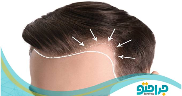 آشنایی با جدیدترین روش های کاشت مو سال 1401 آشنایی با جدیدترین روش های کاشت مو سال 1401