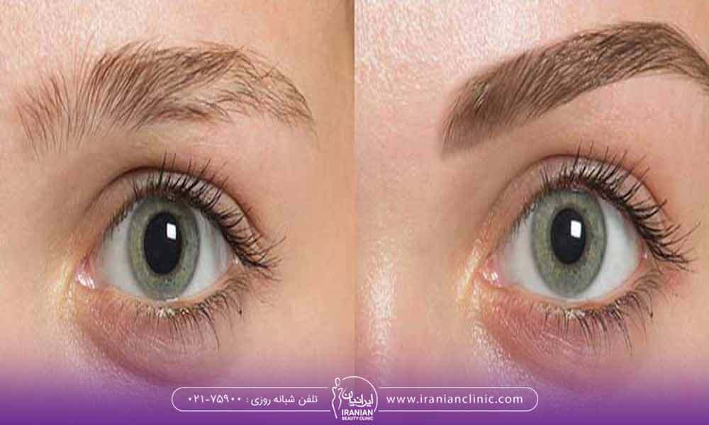 زیبایی چشم‌های خود را با کاشت ابرو دو برابر کنید