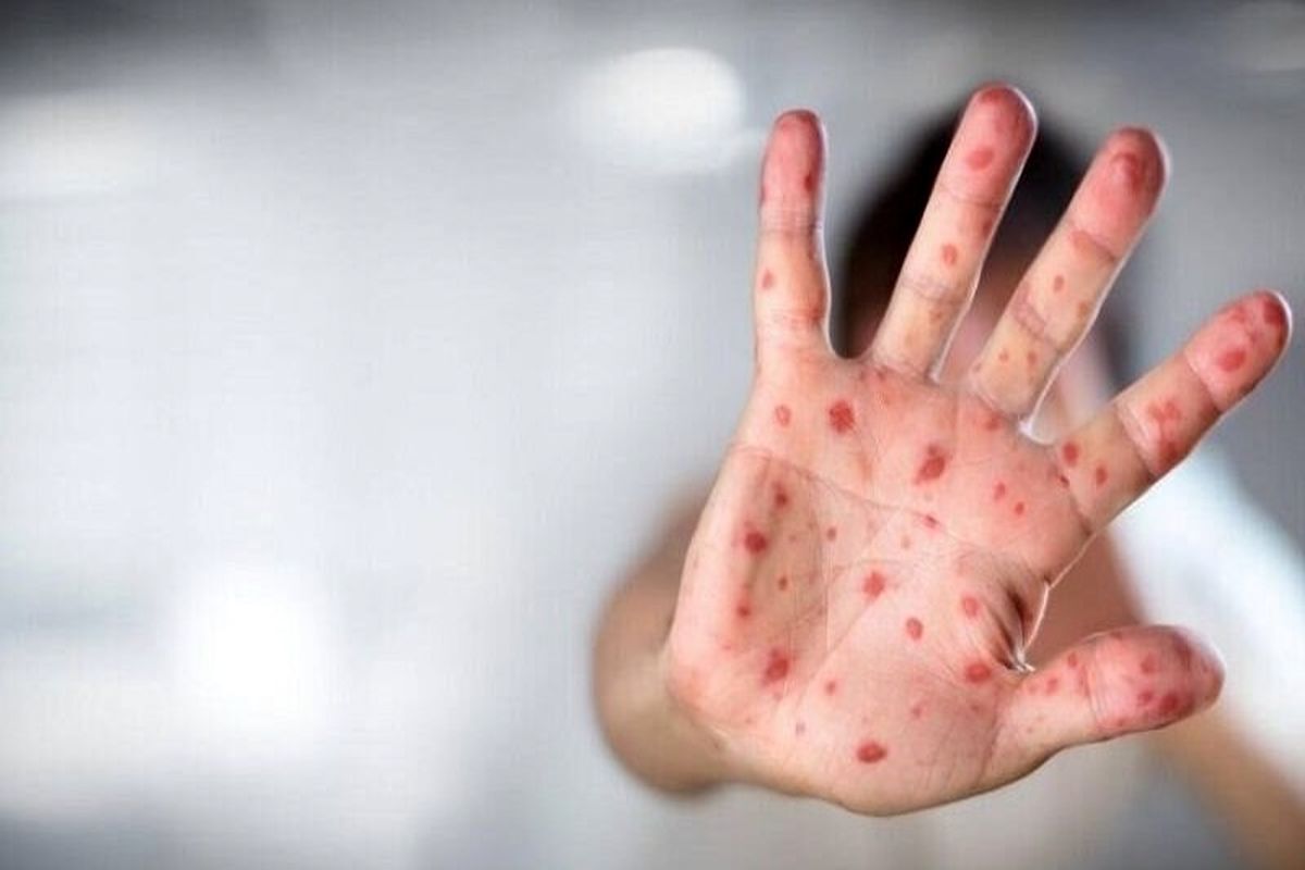 افزایش خطر سکته قلبی با ویروس آبله مرغان نهفته افزایش خطر سکته قلبی با ویروس آبله مرغان نهفته