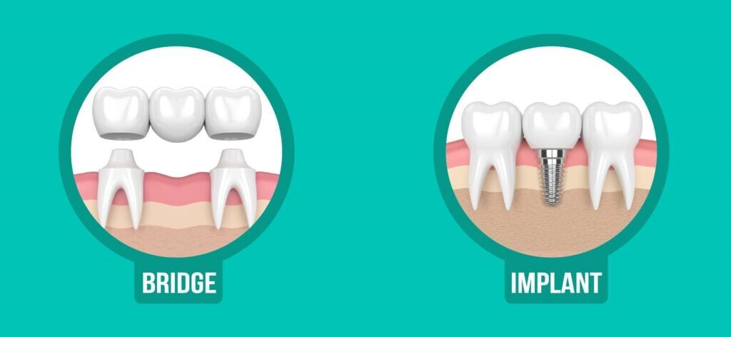 جایگزینی دندان کشیده شده جایگزینی دندان کشیده شده
