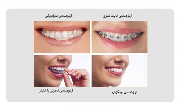 چرا ارتودنسی نامرئی سریع ترین روش مرتب کردن دندان هاست؟