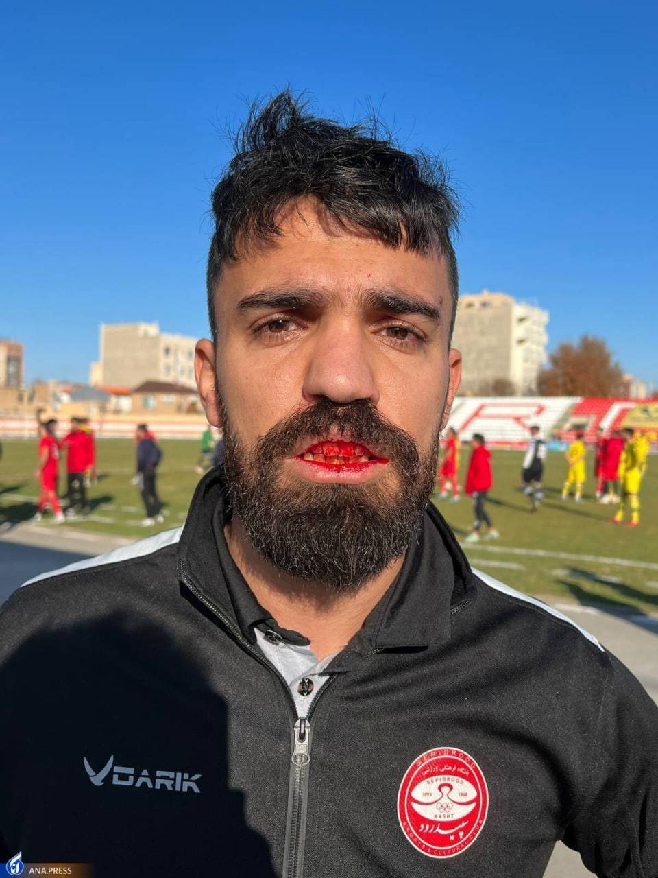 جنجال و خونریزی در دیدار سپیدرود رشت - نود ارومیه+عکس