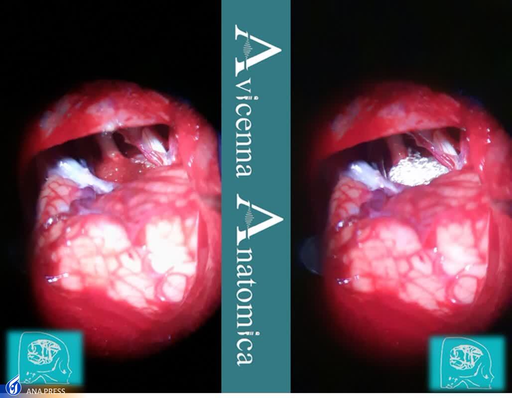 تولید محصول دانش‌بنیان «مِش تیتانیومی» که زمان جراحی و خونریزی را کاهش می‌دهد/ مشکل میکروسکوپ‌های فاقد اتصال دوربین با «میکروسرجری» رفع شد