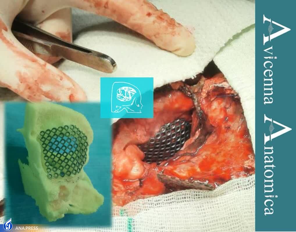 تولید محصول دانشبنیان «مِش تیتانیومی» که زمان جراحی و خونریزی را کاهش میدهد/ مشکل میکروسکوپهای فاقد اتصال دوربین با «میکروسرجری» رفع شد تولید محصول دانشبنیان «مِش تیتانیومی» که زمان جراحی و خونریزی را کاهش میدهد/ مشکل میکروسکوپهای فاقد اتصال دوربین با «میکروسرجری» رفع شد