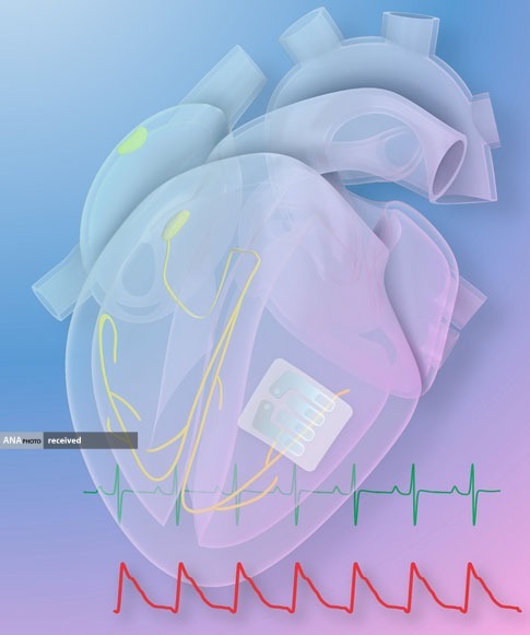 خالکوبی گرافن! درمان آریتمی قلب با نازک ترین ایمپلنت قلبی جهان