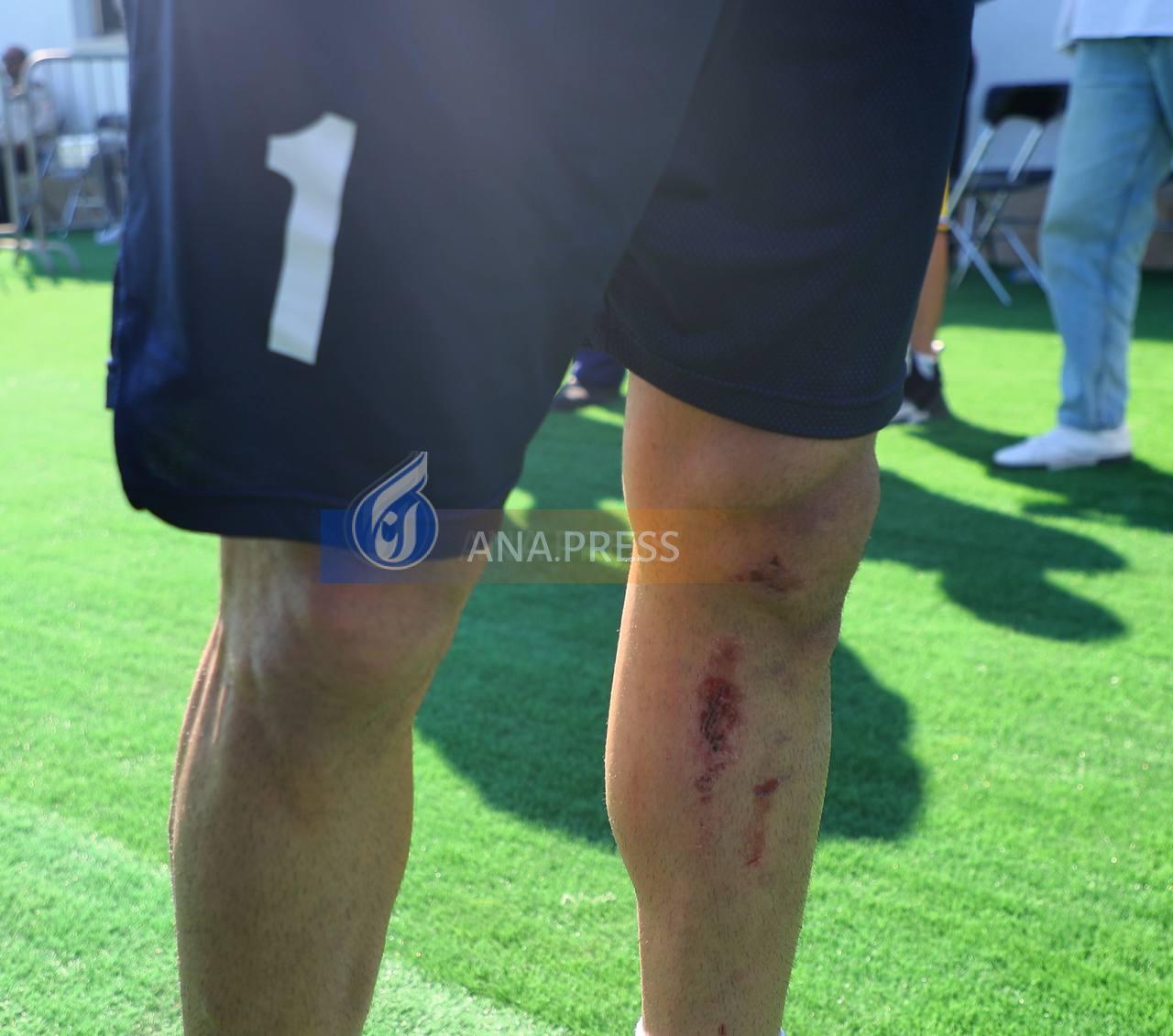 تصاویری از پای آسیب دیده بیرانوند