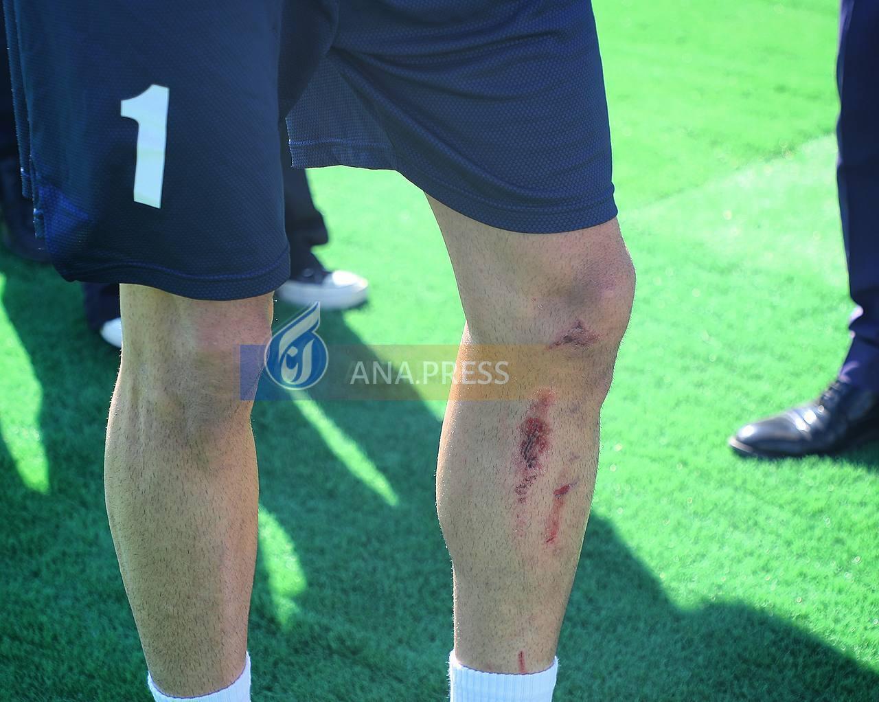 تصاویری از پای آسیب دیده بیرانوند