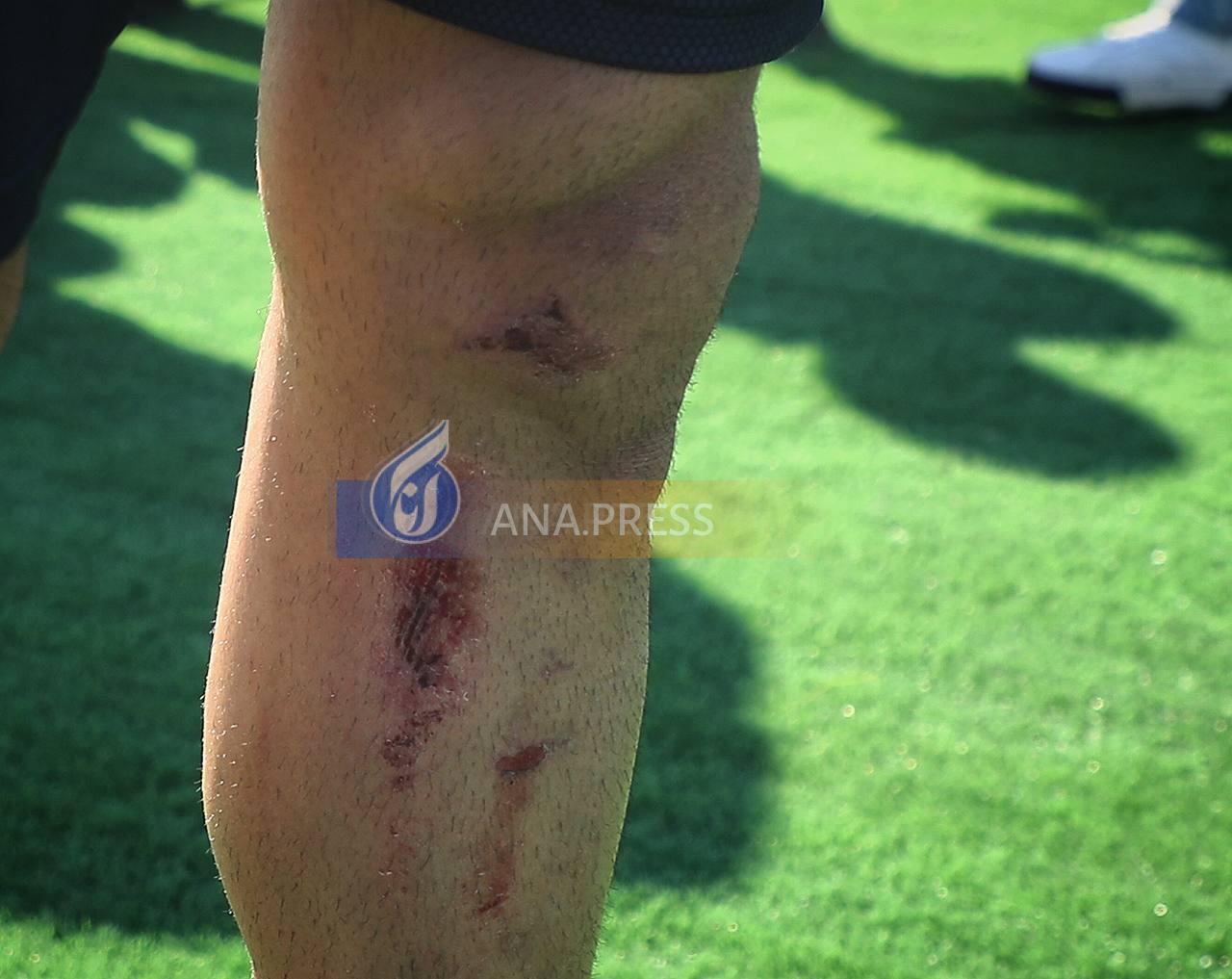 تصاویری از پای آسیب دیده بیرانوند