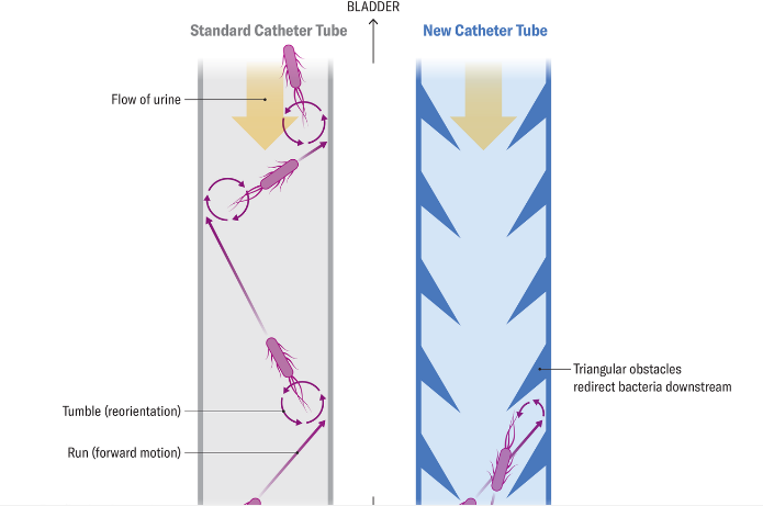 کاهش خطر ابتلا به عفونت ادراری با سوند طراحی شده با هوش مصنوعی کاهش خطر ابتلا به عفونت ادراری با سوند طراحی شده با هوش مصنوعی