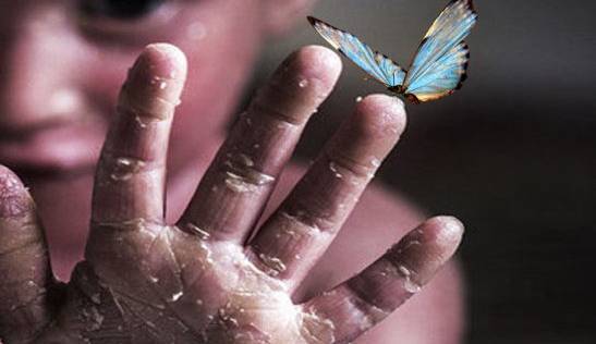 بیماری پروانه‌ای؛ زخم‌هایی به ظرافت بال‌های پروانه