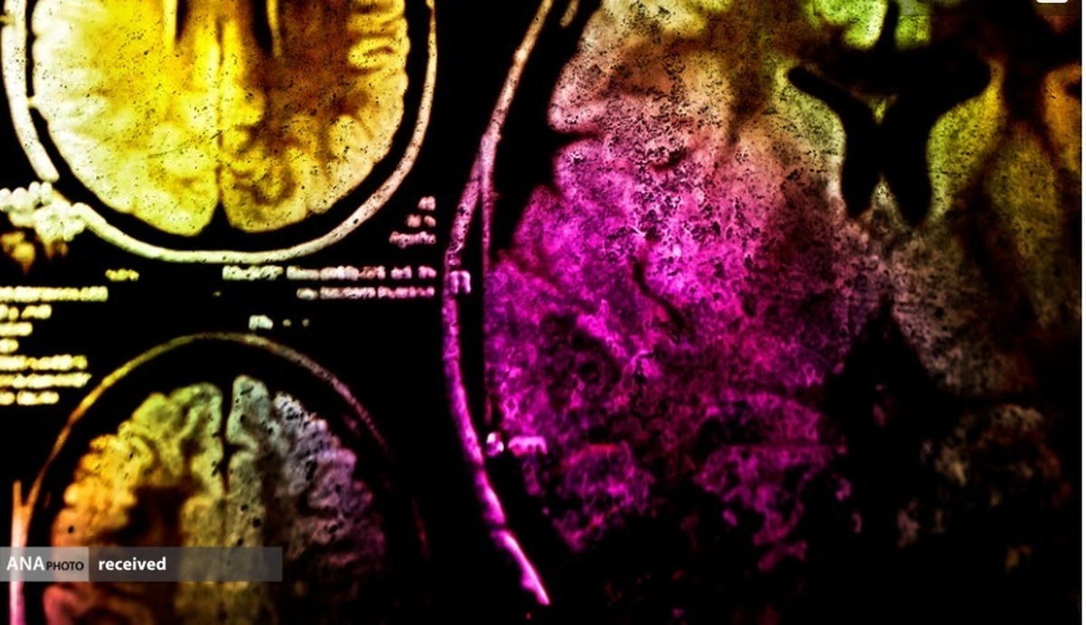 جلوگیری از بازگشت سرطان مغز با ابداع «هیدروژل دوگانه»