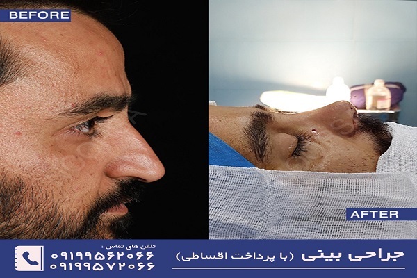 هزینه عمل بینی در سال ۱۴۰۲ و عوامل موثر بر هزینه هزینه عمل بینی در سال ۱۴۰۲ و عوامل موثر بر هزینه