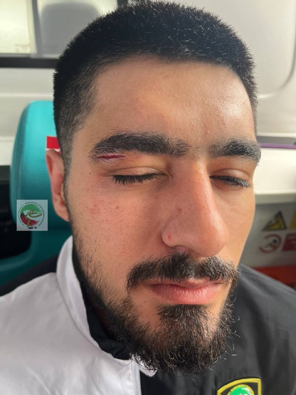 مصدومیت برخورداری از ناحیه ابرو حین تمرین