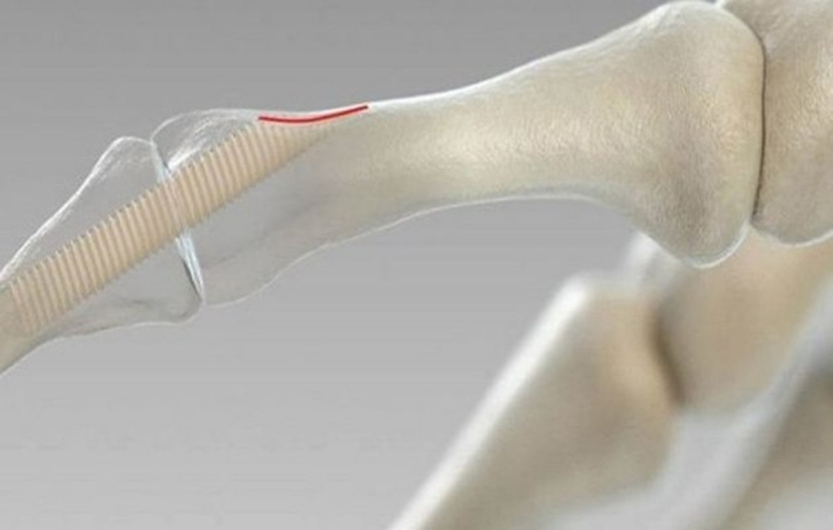 تثبیت‌کننده‌های زیست‌تخریب‌پذیر استخوانی ساخته شد  کاربرد در جراحی‌های ارتوپدی