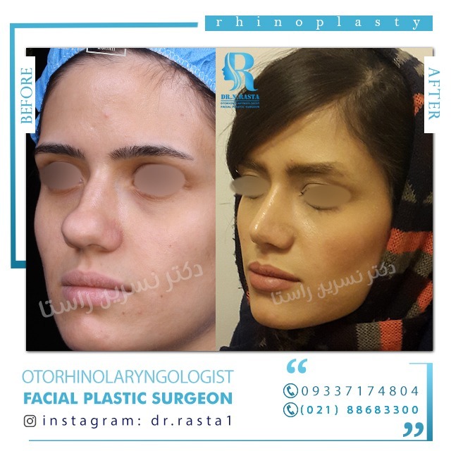 جراحی بینی در خانمهای مسن جراحی بینی در خانمهای مسن