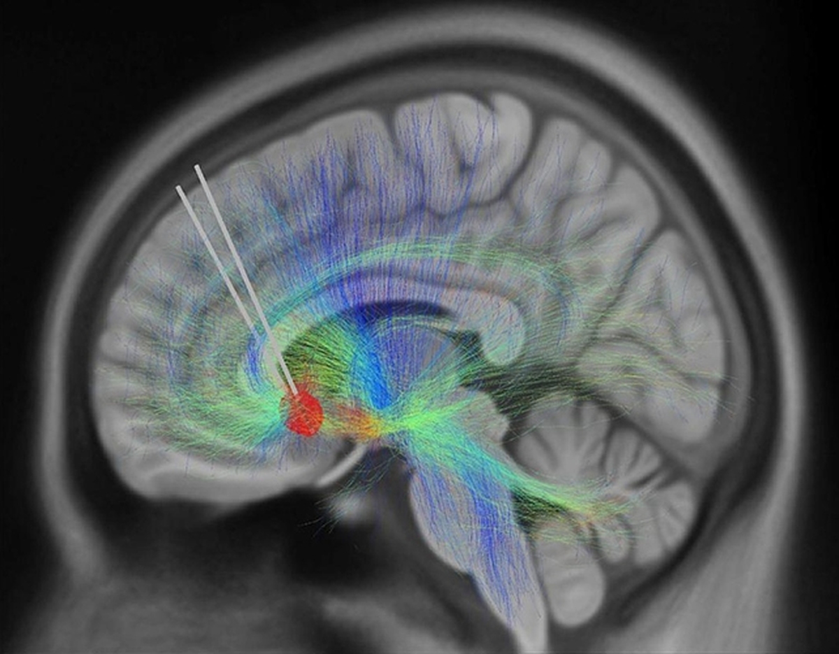 هوش مصنوعی سیگنال‌های مغزی مرتبط با افسردگی را شناسایی می‌کند