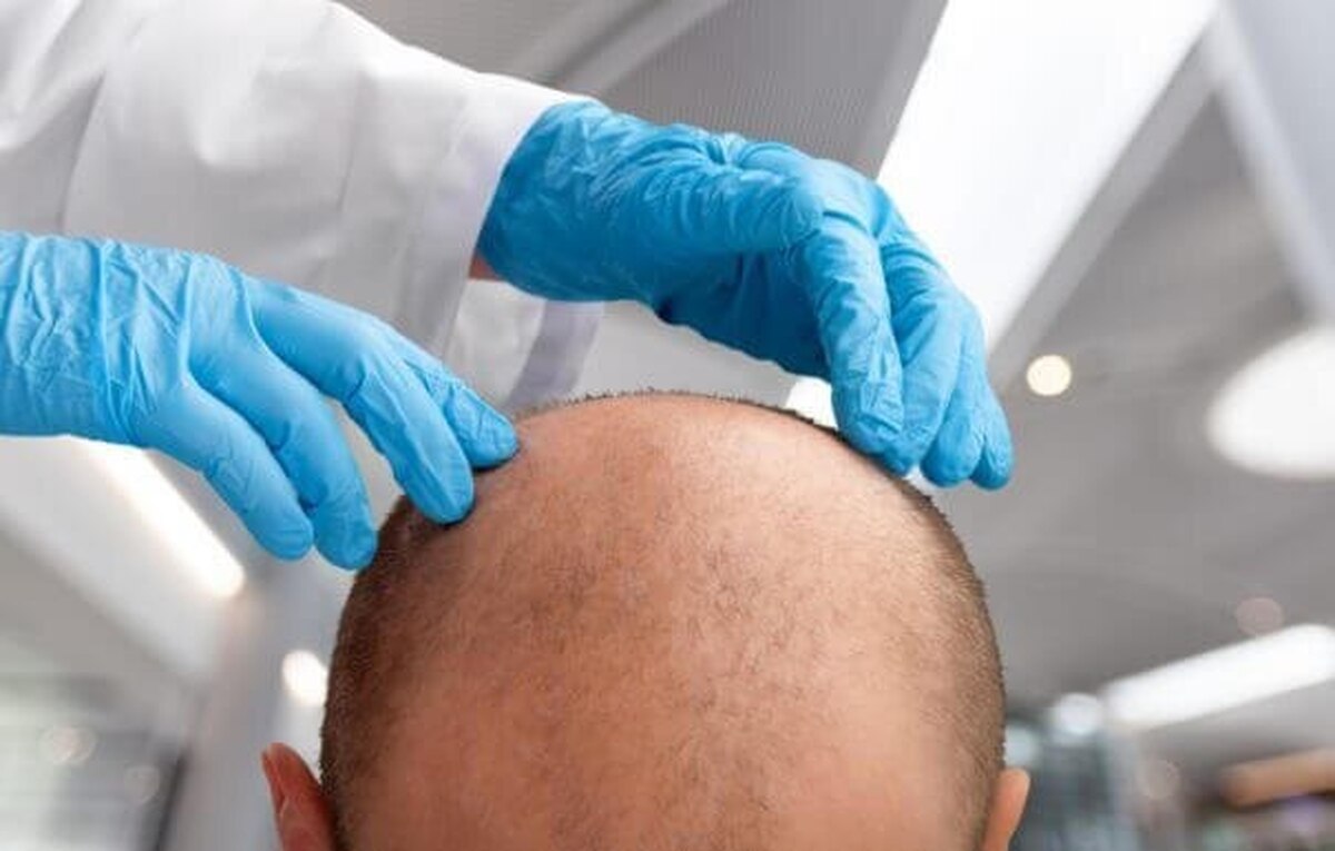 کلید درمان ژنتیک ریزش مو شناسایی شد