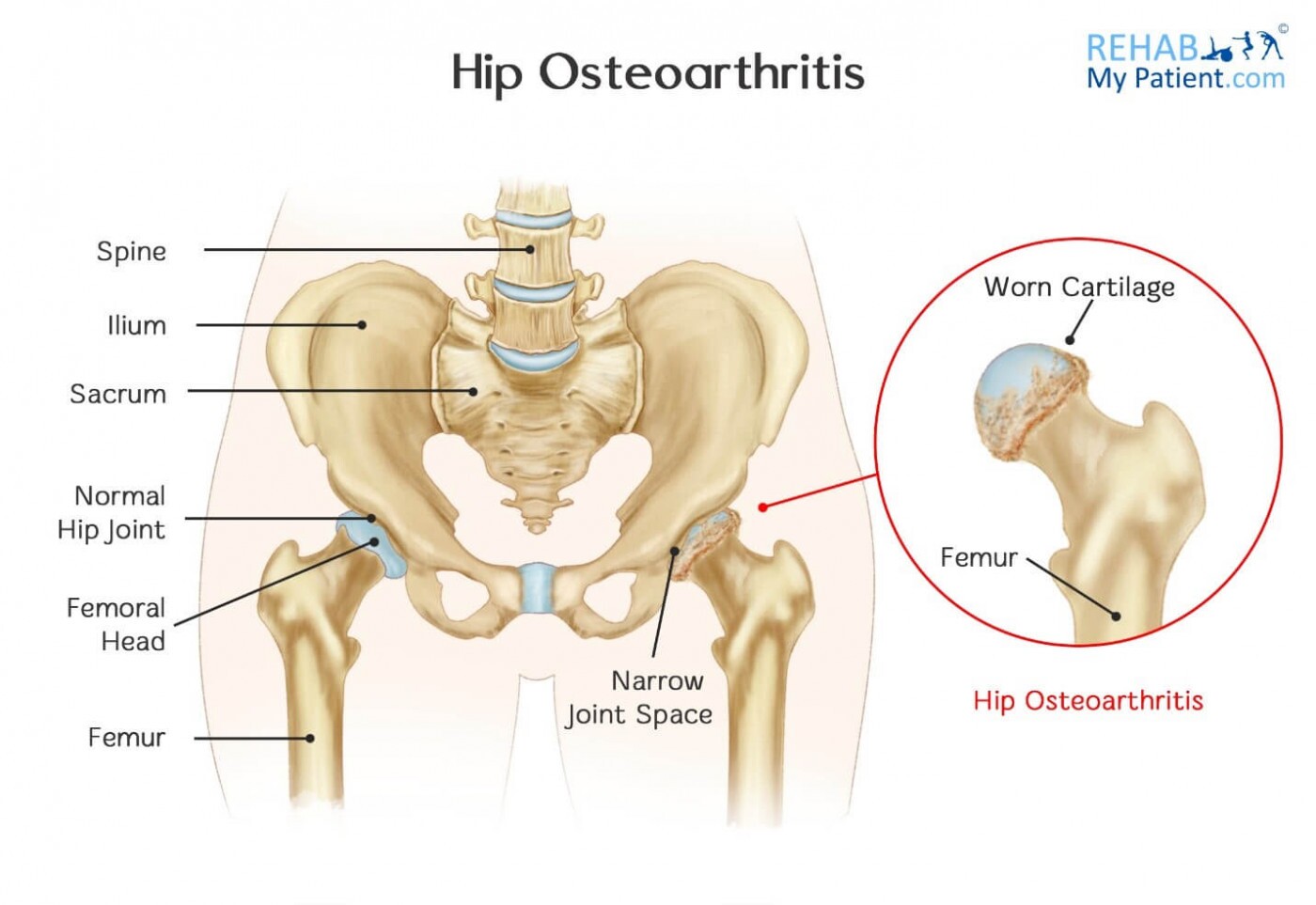 ارتباط مستقیم بین آرتروز لگن و درد مزمن چند موضعی دارد ارتباط مستقیم بین آرتروز لگن و درد مزمن چند موضعی دارد