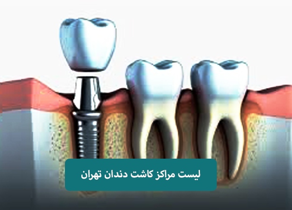 لیست مرکز کاشت دندان در تهران