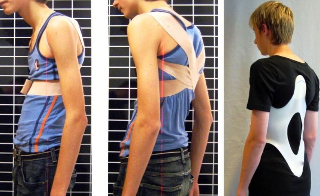 ناهنجاری کیفوز (گردپشتی- گوژپشتی- قوزپشتی) ناهنجاری کیفوز (گردپشتی- گوژپشتی- قوزپشتی)